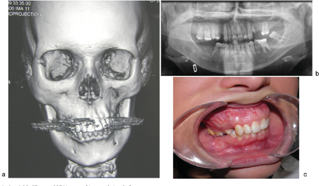 Craniomaxillofacial Trauma